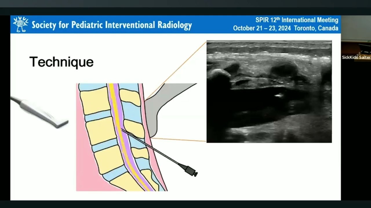 Enhancing Infant Lumbar Punctures with the Small Tap Device