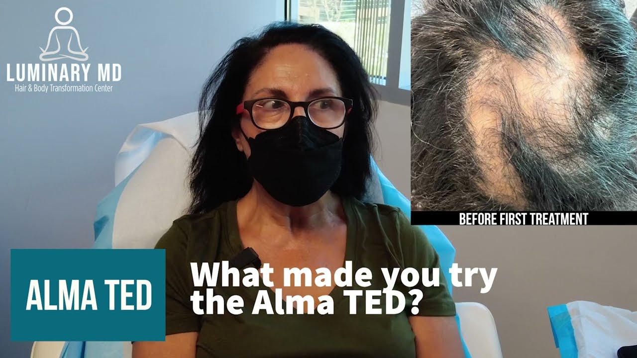Patient Testimony using the Alma TED for hair restoration in Orange County with Dr. Milanes, MD