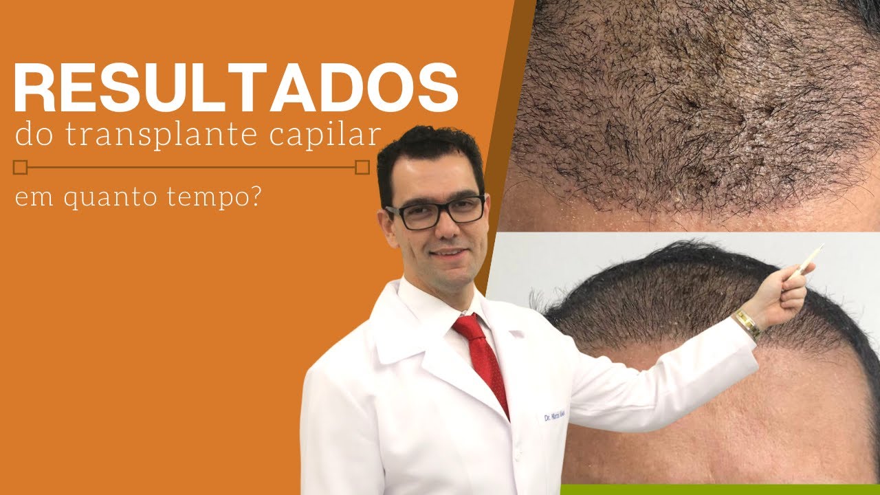 Quando começo a ver o resultado do transplante capilar?