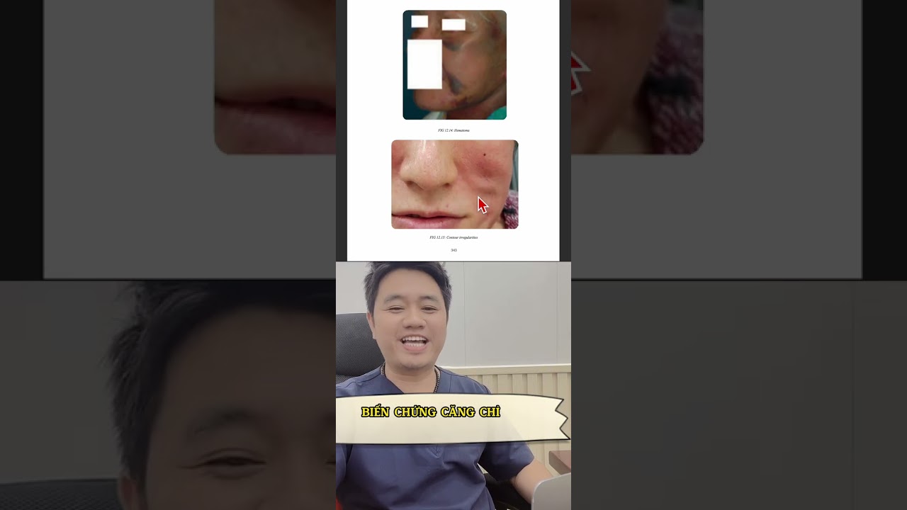 biến chứng căng chỉ #cangchi #bienchungcangchi #nhiemtrungcangchi #xuhuongyoutube