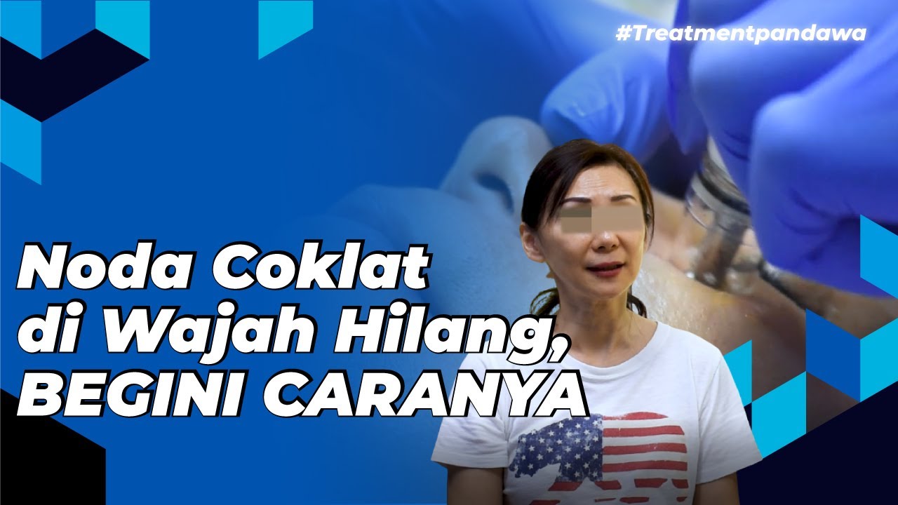 Singkirkan bercak cokelat melasma tanpa sakit
