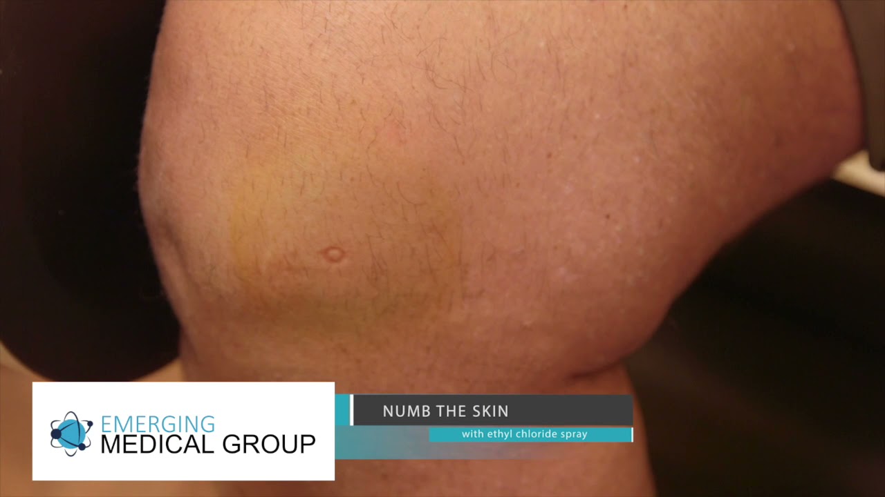 PRP Instructions Knee PRP Protocol