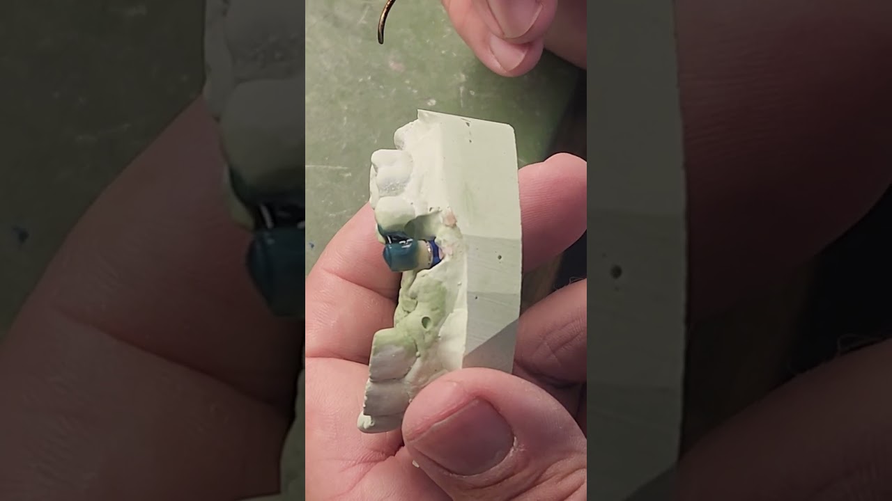 waxing an implant crown so that access hole comes out the lingual