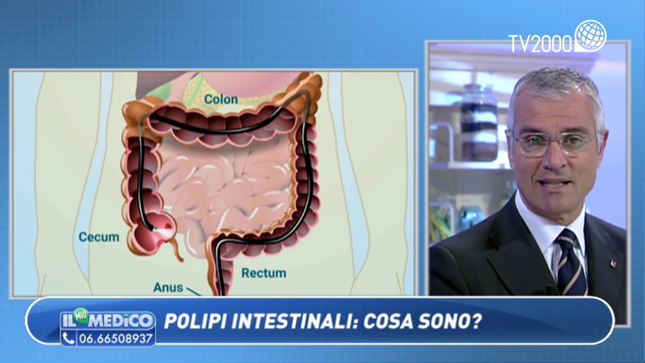 Il Mio Medico - Polipi intestinali: cosa sono?