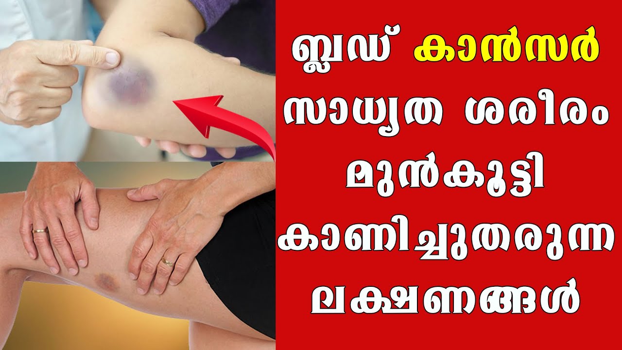 ബ്ലഡ്‌ കാന്‍സര്‍ ശരീരം വളരെ മുന്‍കൂട്ടി കാണിച്ചുതരുന്ന ലക്ഷണങ്ങള്‍ @BaijusVlogsOfficial