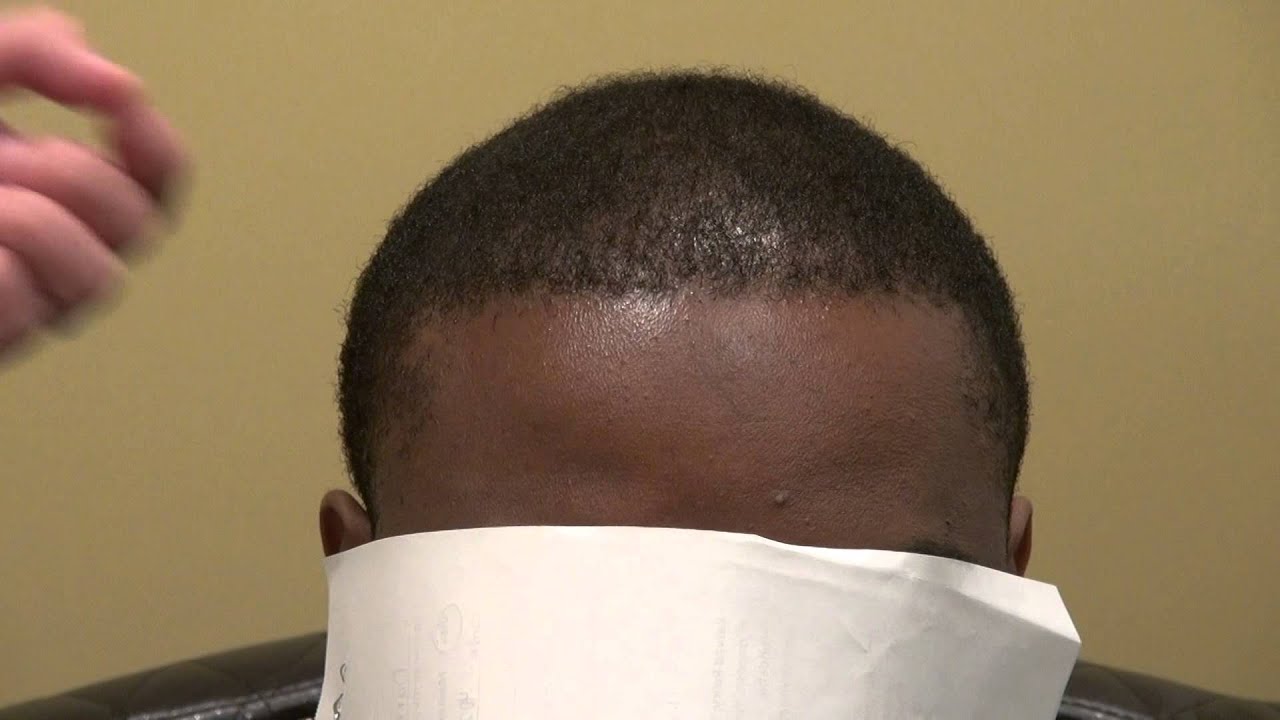 Black Hairline FUE Hair Loss Transplant Surgery 12 Months Result Dr. Diep www.mhtaclinic.com
