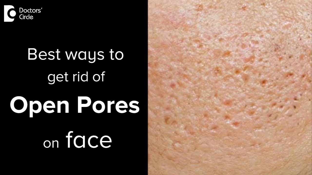 What are open pores and treatment options for that? - Dr. Vignesh Raj