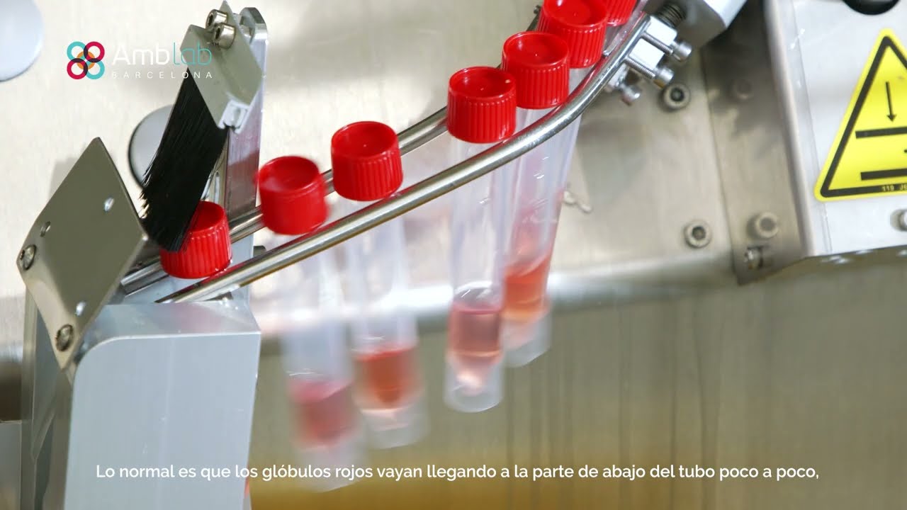 PRUEBA DE VELOCIDAD DE SEDIMENTACI&Oacute;N GLOBULAR │&iquest;En qu&eacute; consiste?