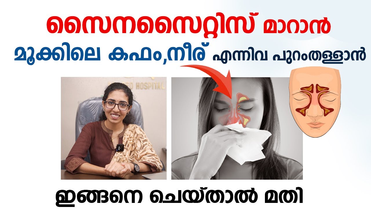 സൈനസൈറ്റിസ് പൂർണ്ണമായി മാറാൻ ഇങ്ങനെ ചെയ്താൽ മതി | Sinusitis Malayalam | Arogyam