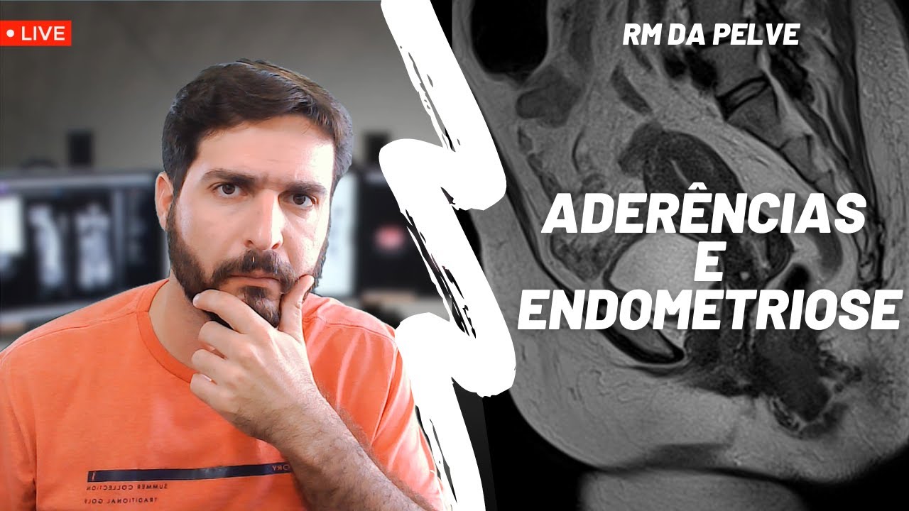 Endometriose causa aderências e dor pélvica? Veja neste vídeo! | Galvani Filho