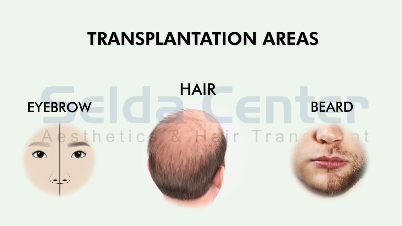 Hair Transplant Informative Video | Selda Center