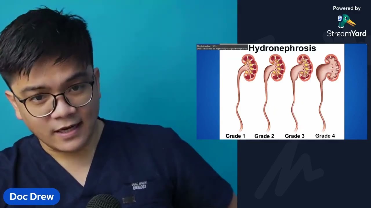 Hydronephrosis explained | Doc Drew Urologist