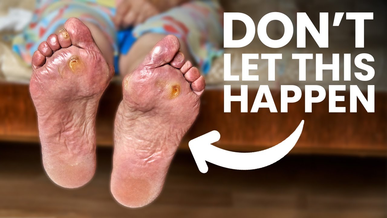 Why Foot Care is Important For Diabetics (Could be Urgent)
