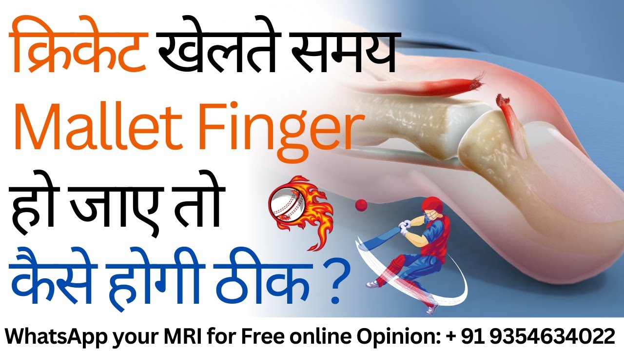 क्रिकेट खेलते समय Mallet Finger हो जाए तो कैसे होगी ठीक ? Mallet Finger in Cricket Injury Treatment