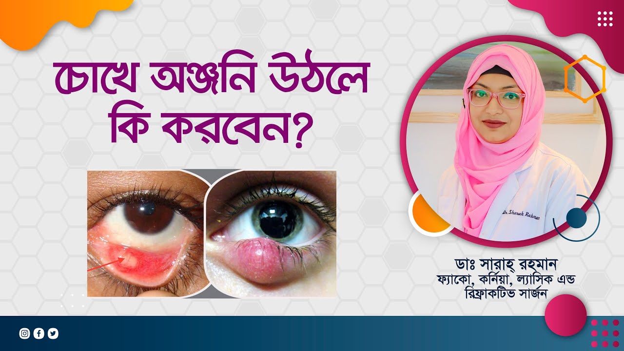 চোখে অঞ্জনির ব্যথা, কী করবেন। চোখ উঠলে কি করণীয়?
