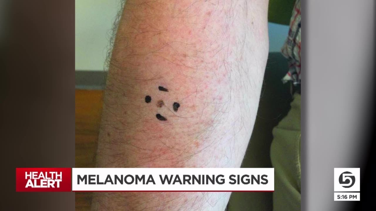 Utah skin cancer researcher raising awareness after surviving melanoma
