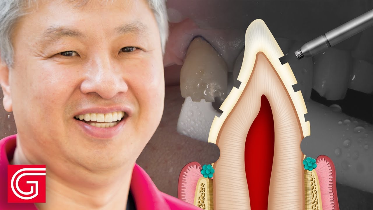 HOW TO  Prepare ANTERIOR Teeth #5-11 for Zirconia Crowns