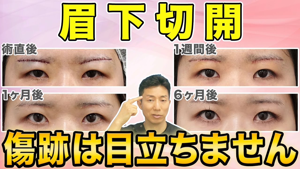 【眉下切開】術後の傷跡を目立たなくするために重要なこと【術者の技量と過ごし方】