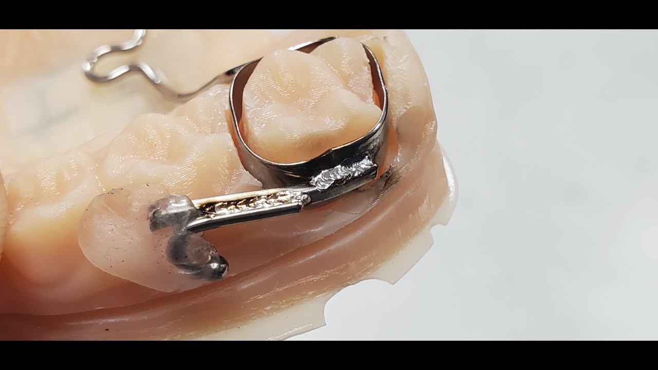 Dental Bar and Wire to Molar Bands