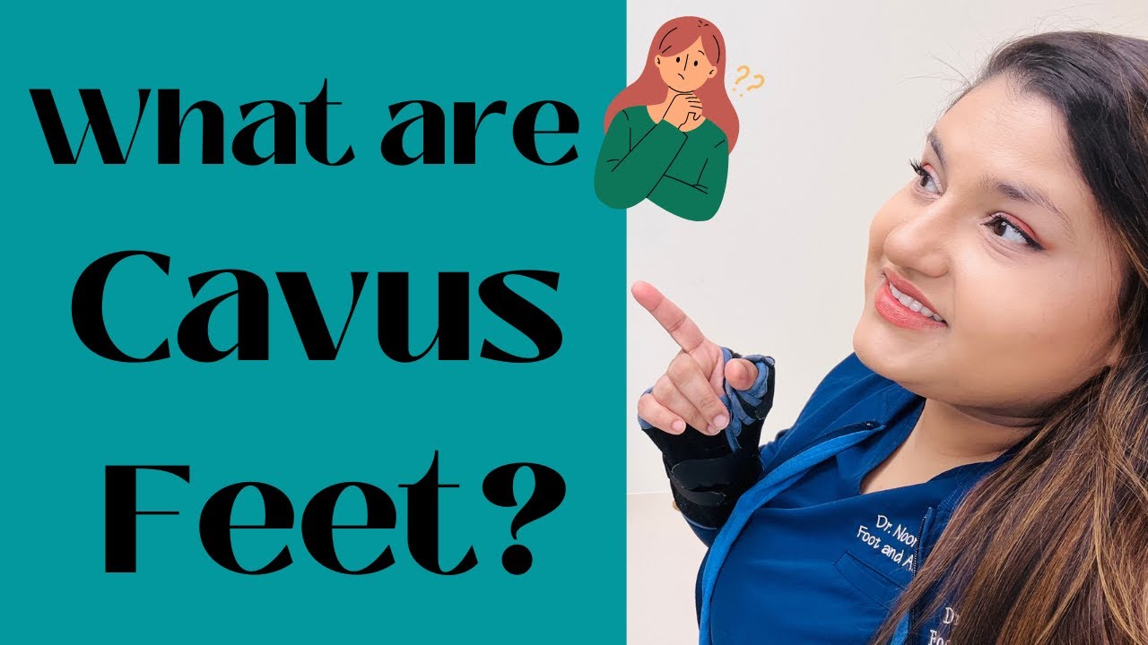 What are Cavus Feet?