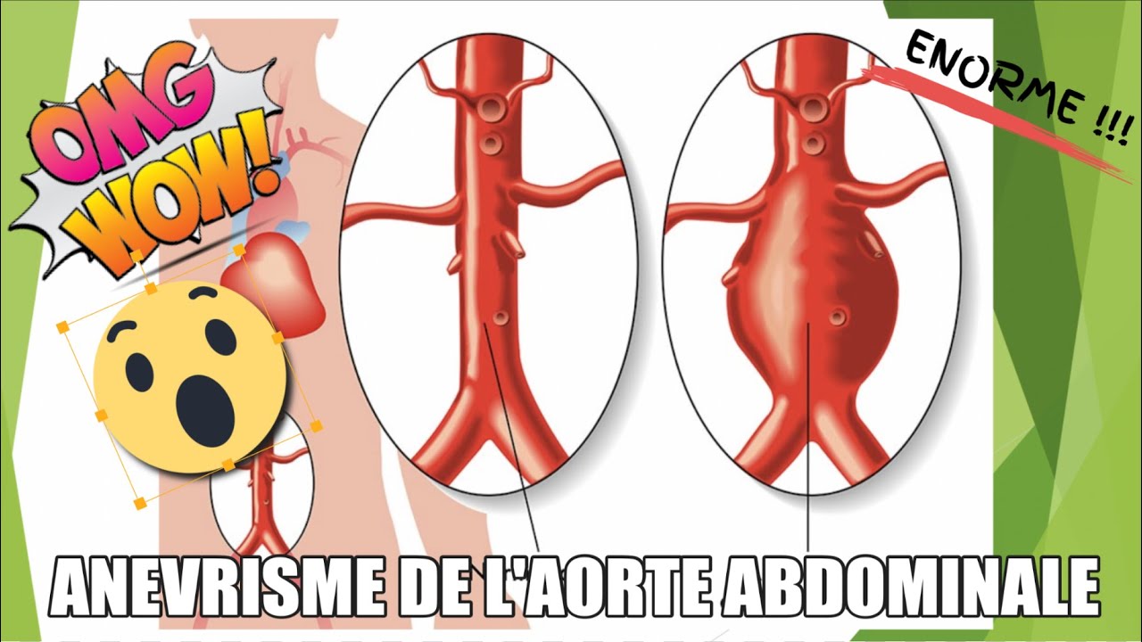 Volumineux anévrisme de l'aorte abdominale en échographie
