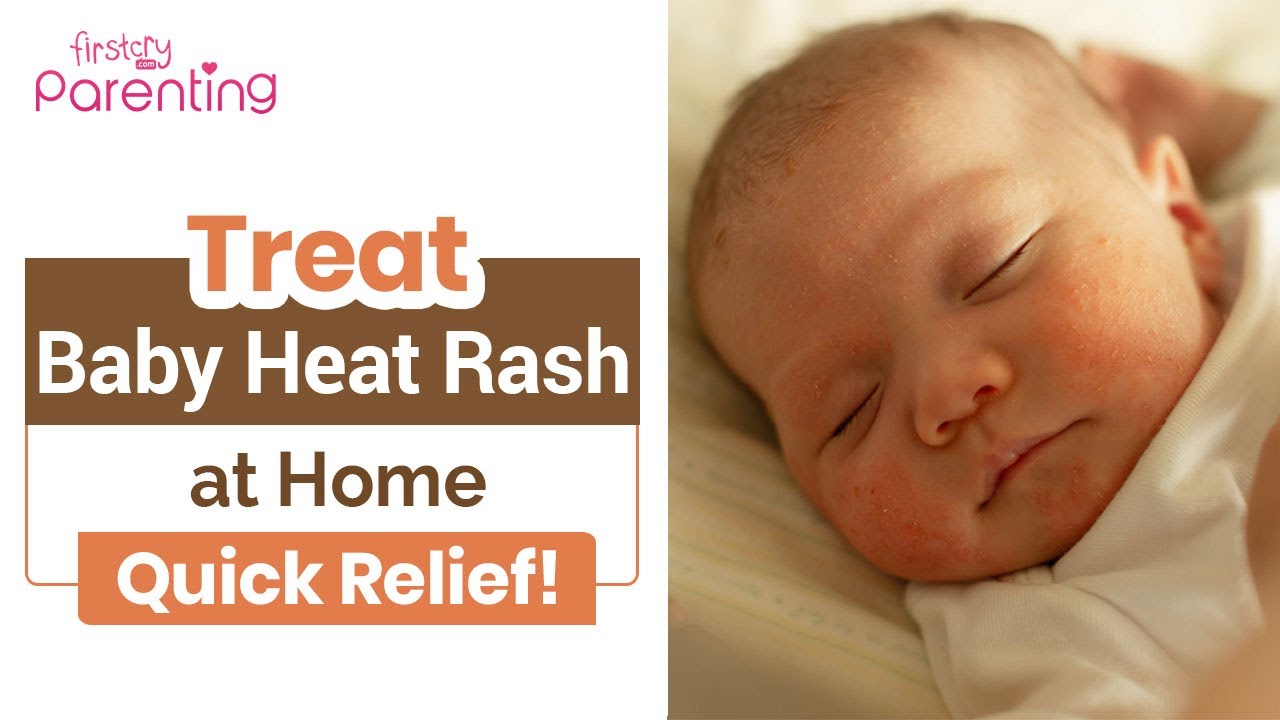 How to Soothe Baby&rsquo;s Heat Rash Naturally at Home | Home Remedies for Baby Heat Rash
