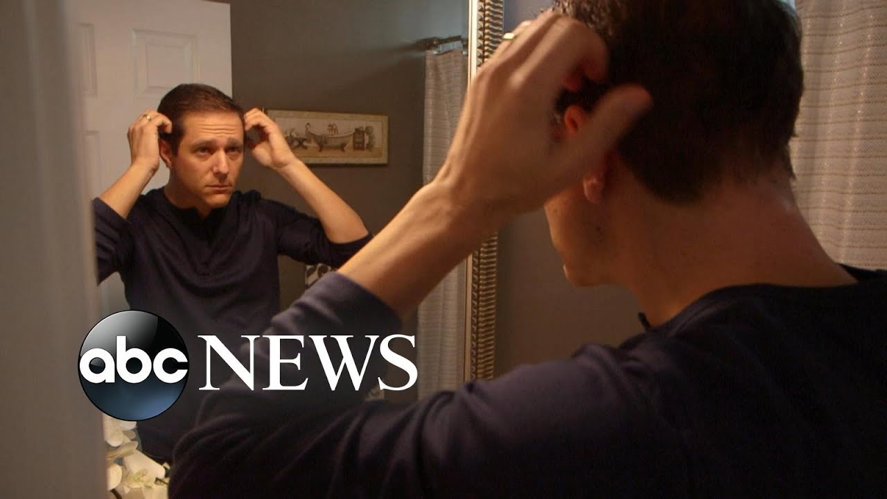 New drug could hold promise for alopecia