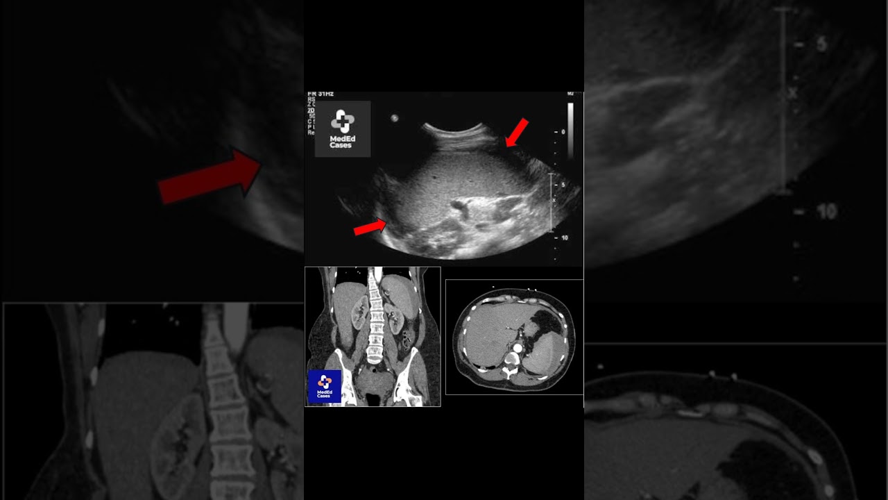 Positive Ultrasound & CT of Splenic Rupture 🚨 #meded #trauma #emergencymedicine #radiology
