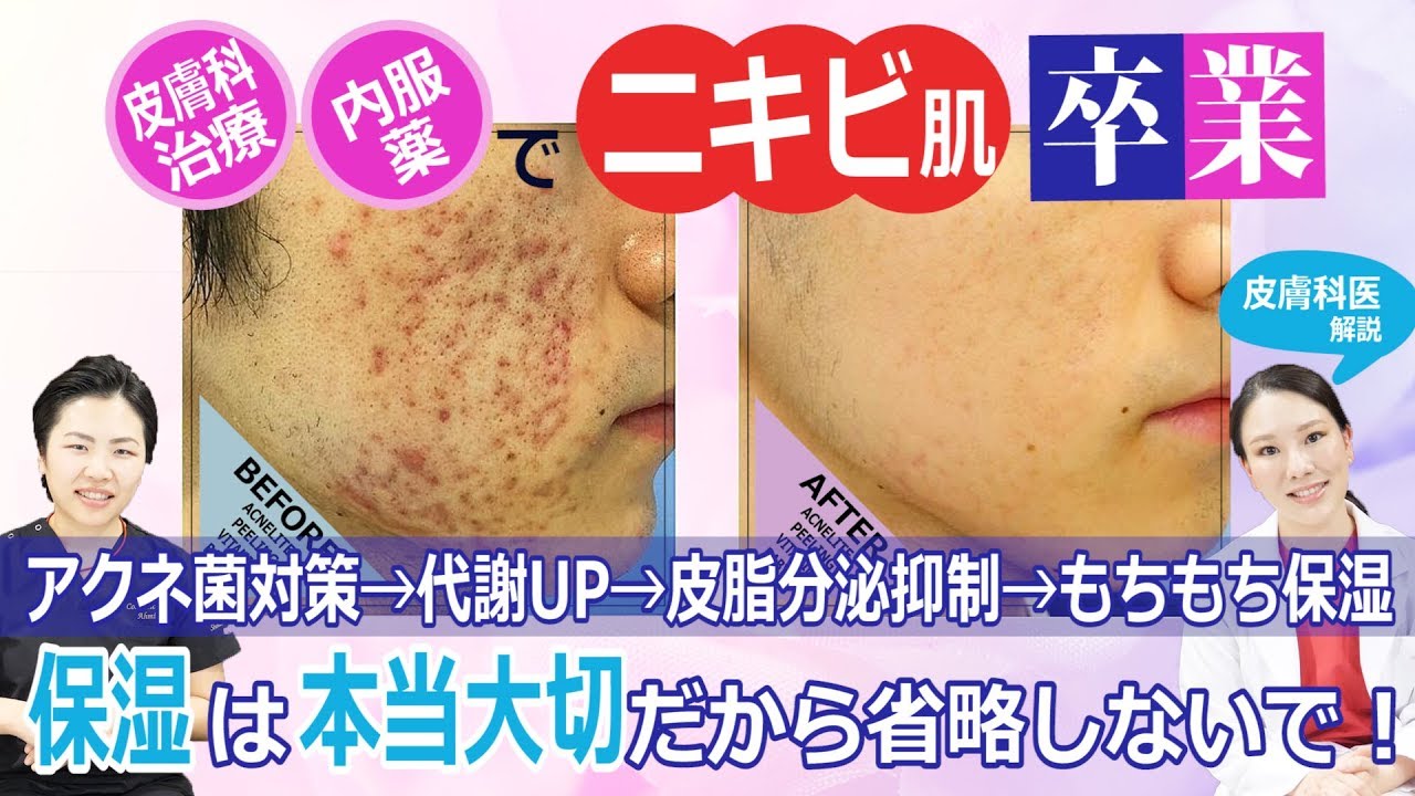 金の部屋【クレーターニキビ肌卒業】皮膚科治療・内服薬で改善できた方法を医師が解説【アクネ菌対策治療＆ピーリング＆保湿】西川礼華医師