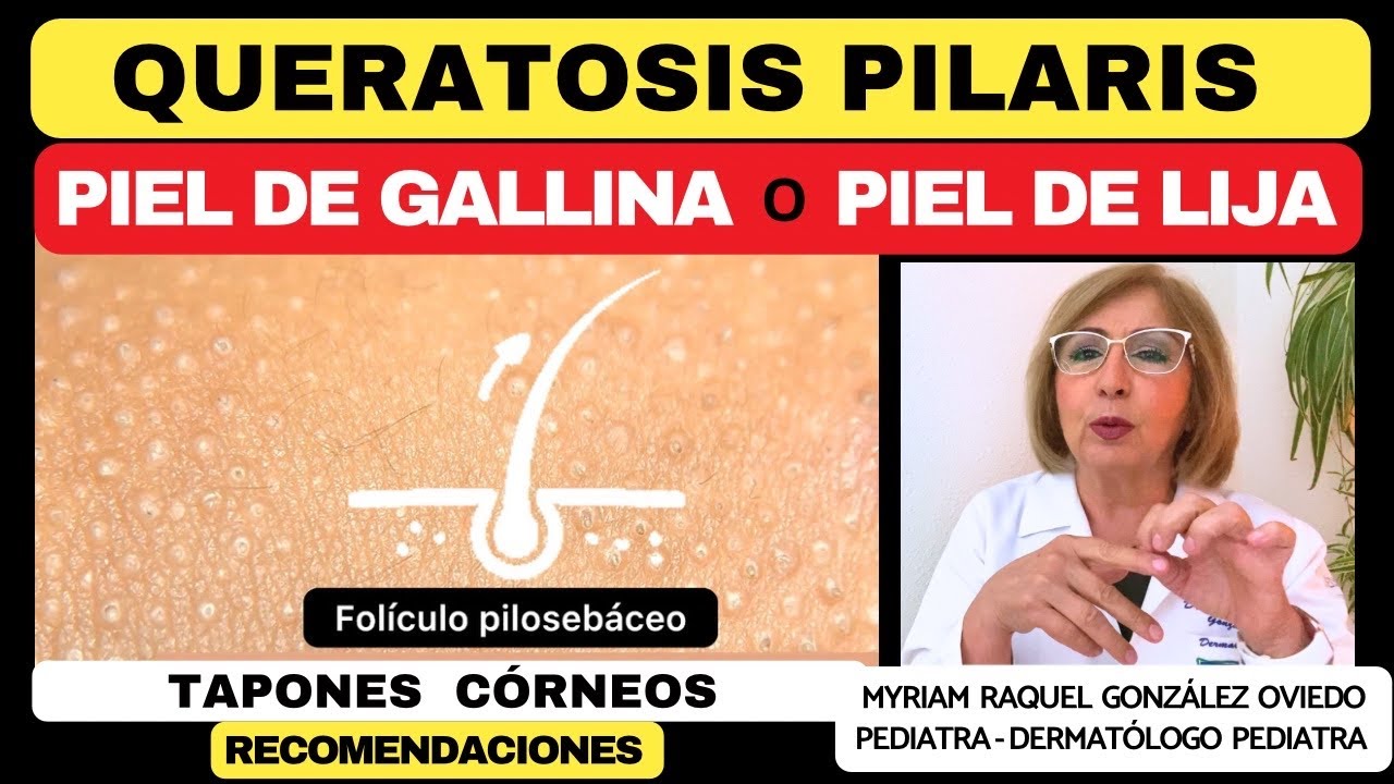 QUERATOSIS PILARIS. GRANOS EN LA PIEL. PIEL DE GALLINA. @depielapiel