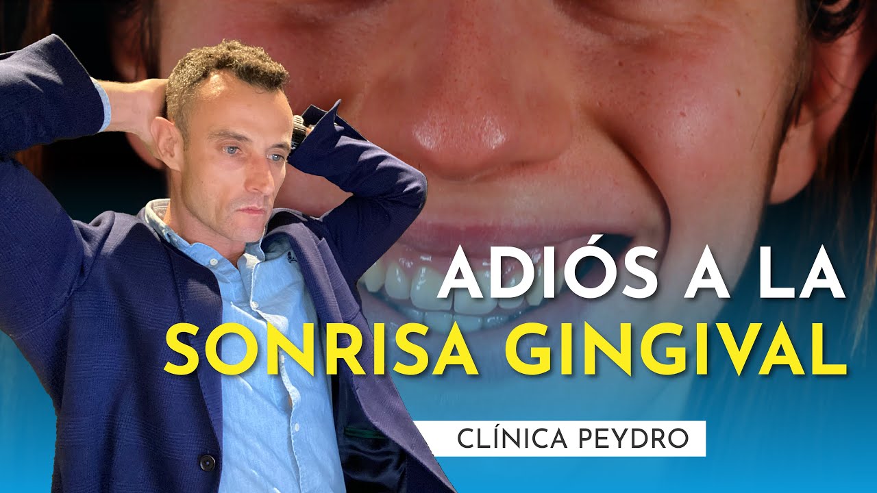 ❌🦷 ¿La sonrisa gingival se puede eliminar? | Clínica Peydro Herrero