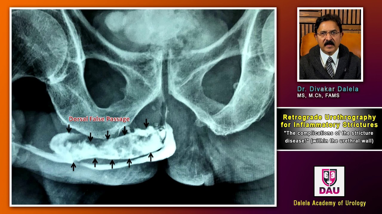 Lect 14 RGU Complications in urethral wall