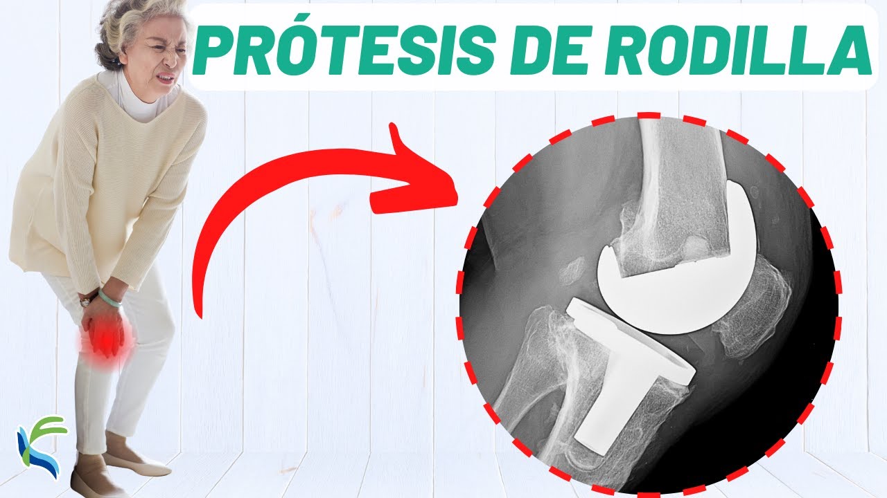 Operación de PRÓTESIS DE RODILLA: resolvemos tus dudas ⚠️
