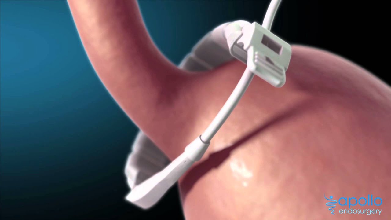 Lap-Band product animation