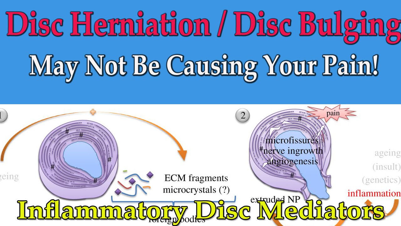 Inflammatory Mediators from the Disc May be Causing Your Pain (Not the Nerve) - Dr Mandell