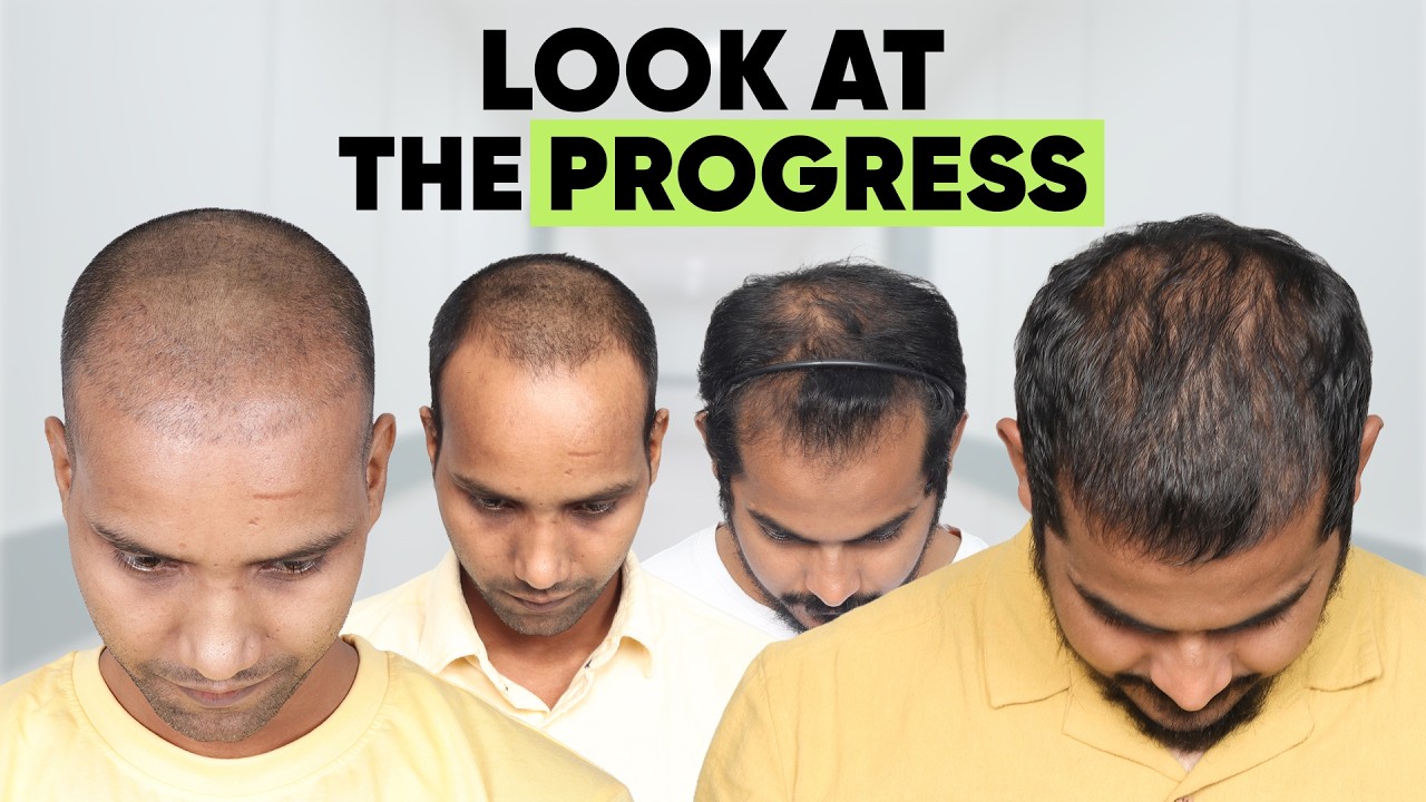 Hair Transplant in Gurgaon (HX-RQAA) | Best Results & Cost of Hair Transplant in Gurgaon