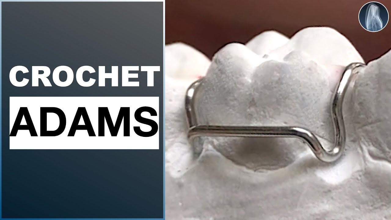Apprendre à façonner un crochet Adams pour la conception d’une orthèse dentaire