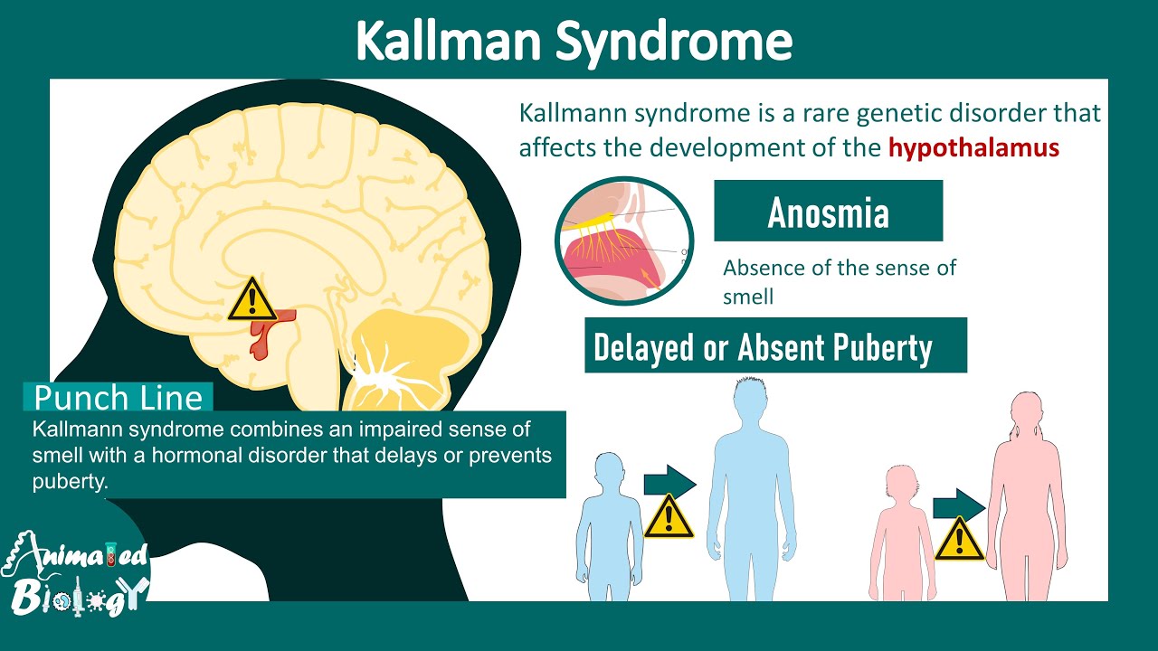 Kallman syndrome | Cause and treatment of Kallman syndrome