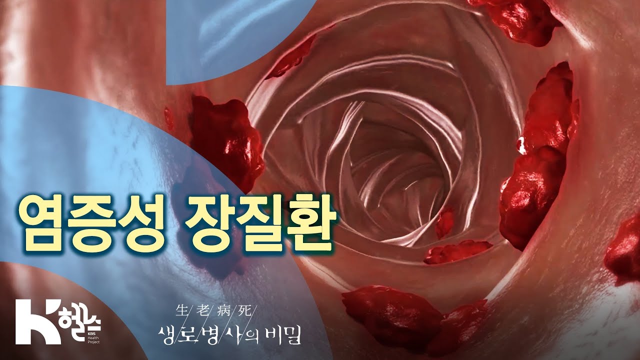 염증성 장질환, 크론병과 궤양성 대장염 - 729회(20.04.22) 질병의 뿌리, 만성염증
