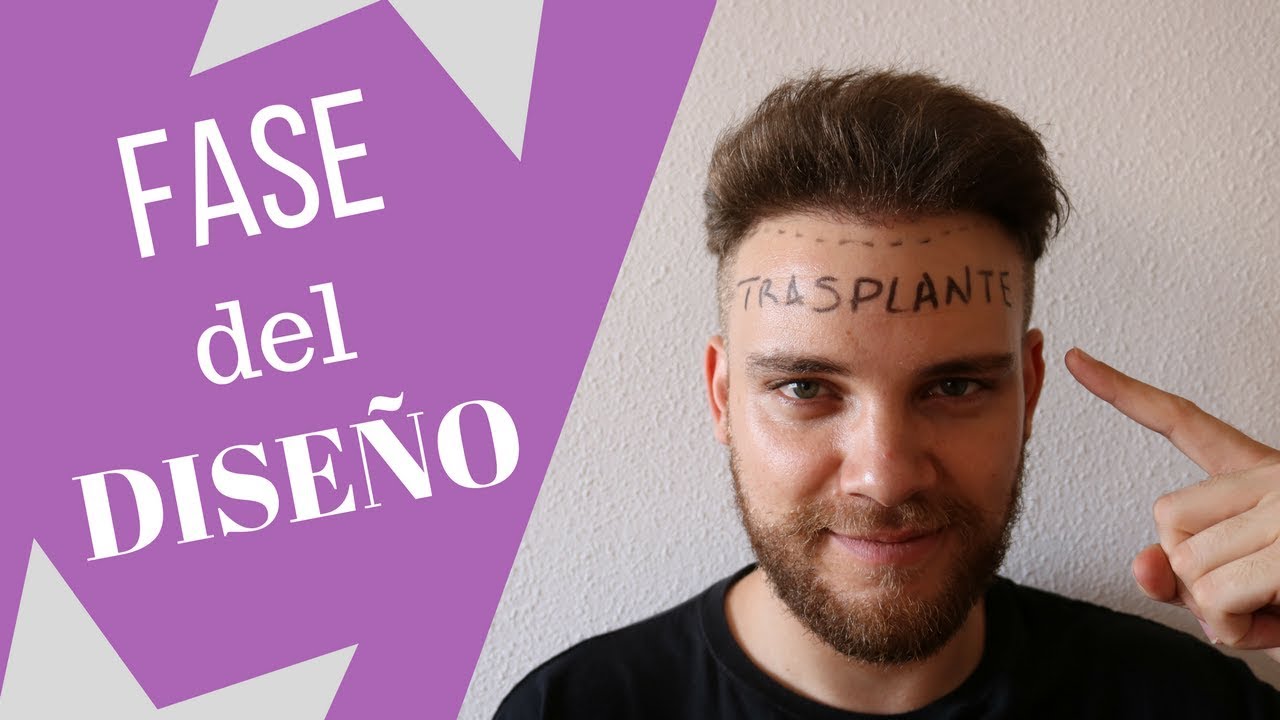 FASE del DISEÑO en un TRASPLANTE DE PELO(CONSEJOS)