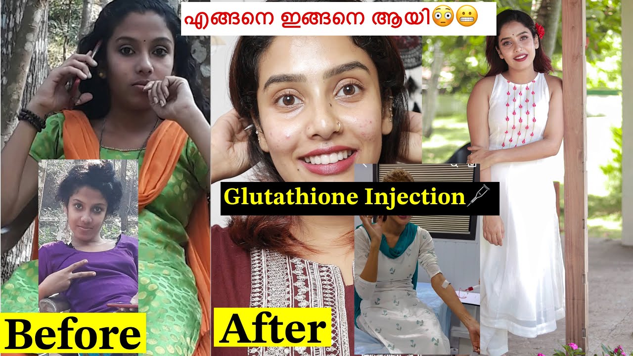 😎5 Years Fairness Cream 🧴Glutathione Injection 🩼എന്റെ മാറ്റത്തിന്റെ കാരണം😳 #glamyganga