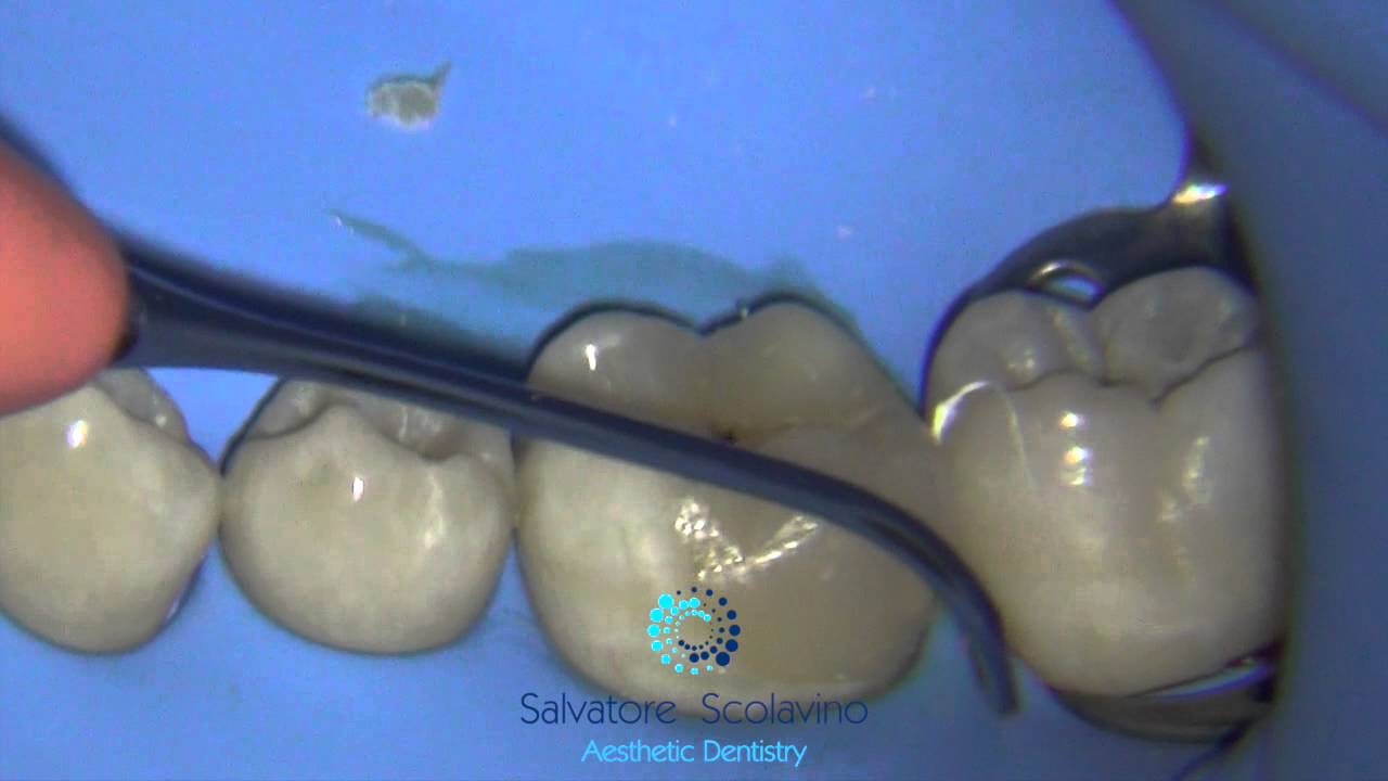 Onlay Cementation