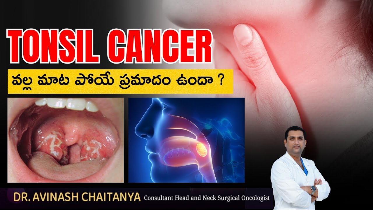 What are the symptoms of tonsil cancer | Dr.Avinash Chaitanya | Kaizen Hematology Oncology Network