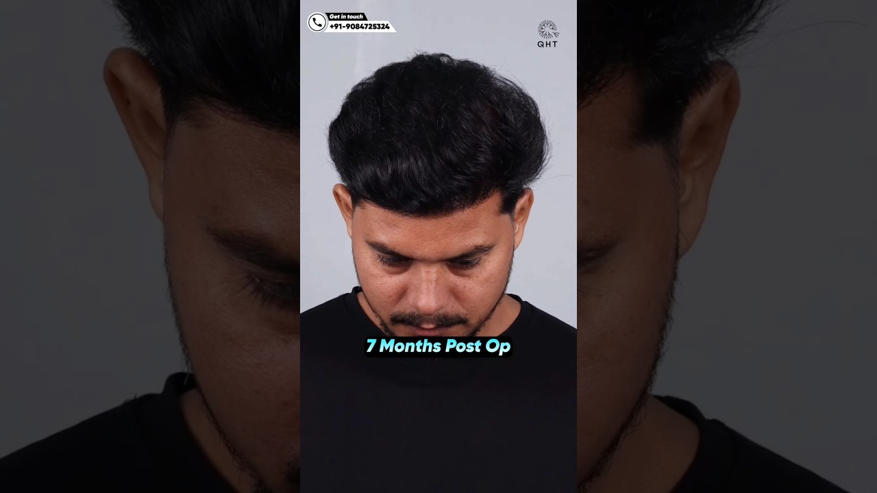 Hair Transplant 7 Months Result #qht #hairtransplant #ytshortsindia #shorts #trending #hairloss #fue