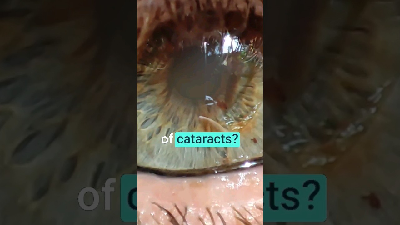WARNING: 4 Early Signs of Cataracts!