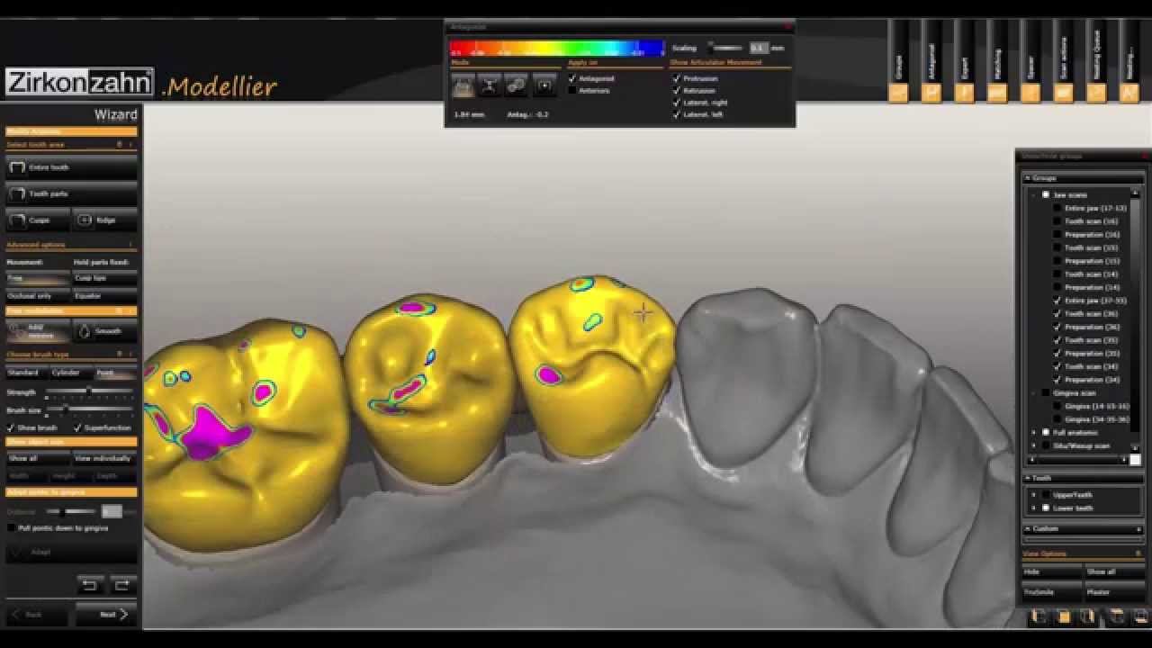 occlusal compass and contact points wax up cad cam design
