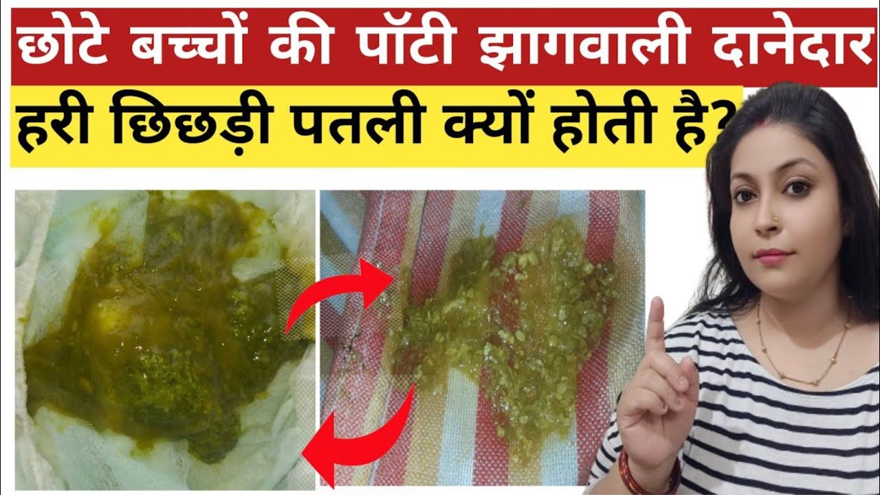 Bache ki Potty Me Jhaag Aana|| Jhag Wali Potty In Baby. बच्चे की पॉटी में झाग आना।
