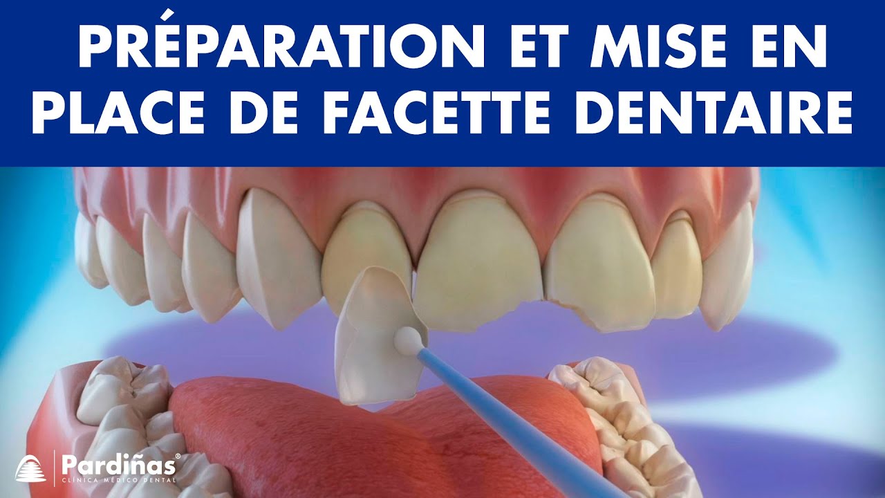 Facette dentaire – Préparation et mise en place des facettes ©