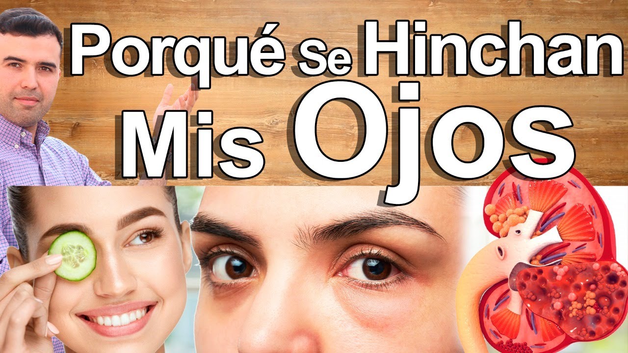 Porqué Tengo Los Ojos Hinchados? - Causas Y Soluciones Para La Hinchazón Y Las Bolsas