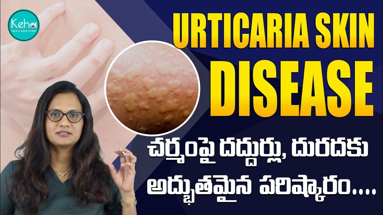 Tips to get rid of Urticaria || Urticaria-Causes & Symptoms || Treatment for Urticaria 
